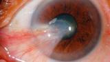 Pterjium