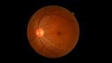Diyabetik Retinopati