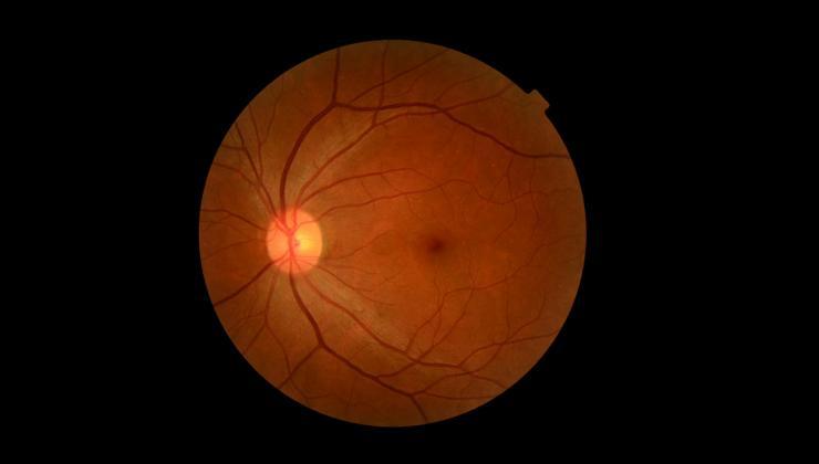 Diyabetik Retinopati