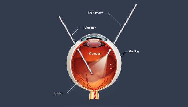 Vitrektomi